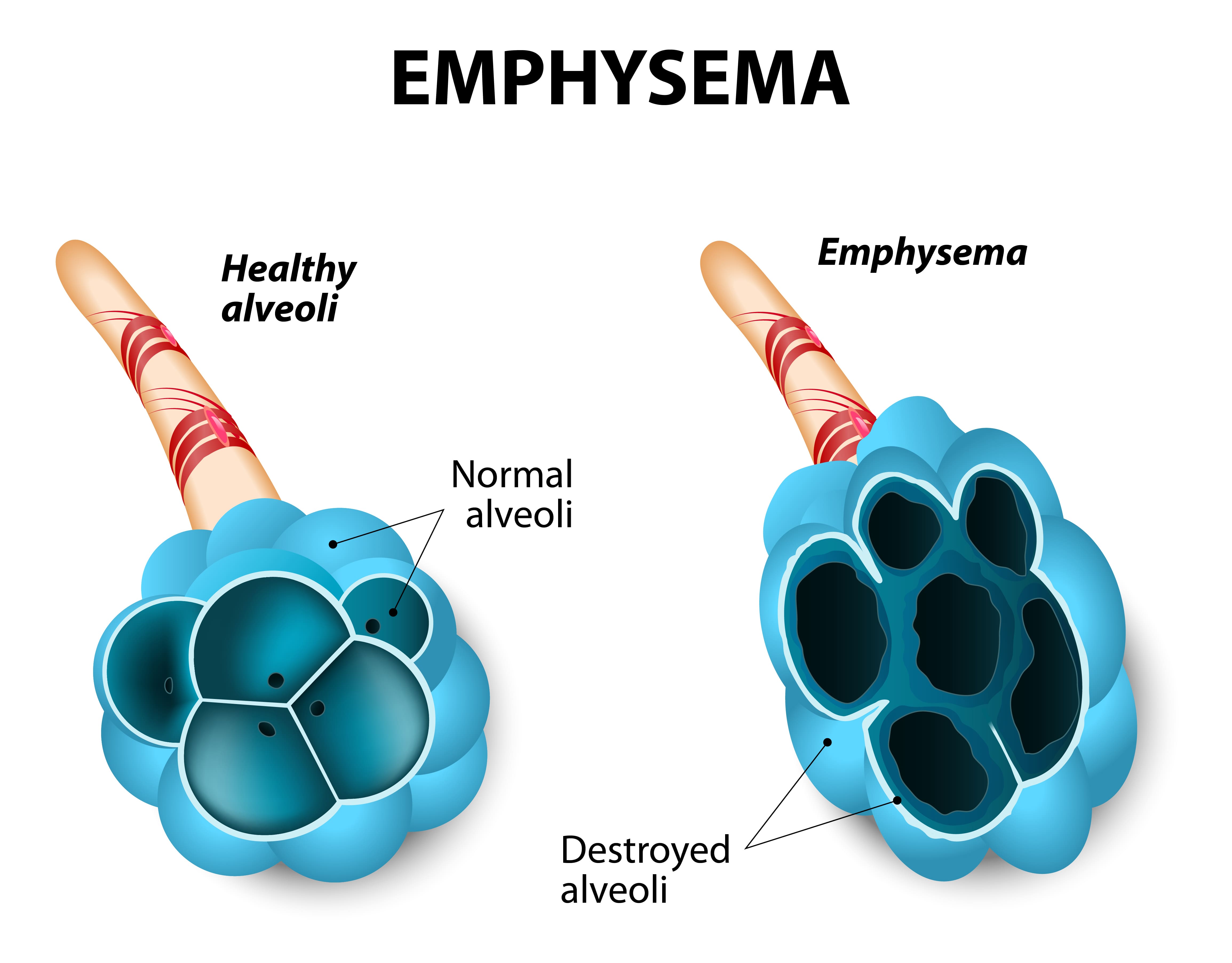Emphysema diagram