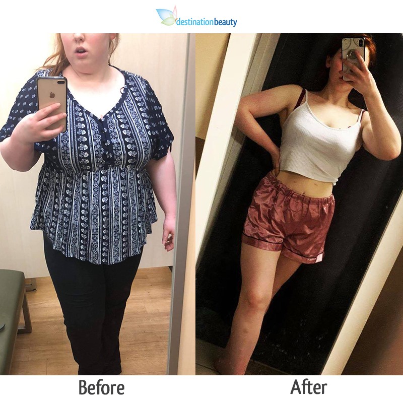 1 Year After Gastric Sleeve Surgery