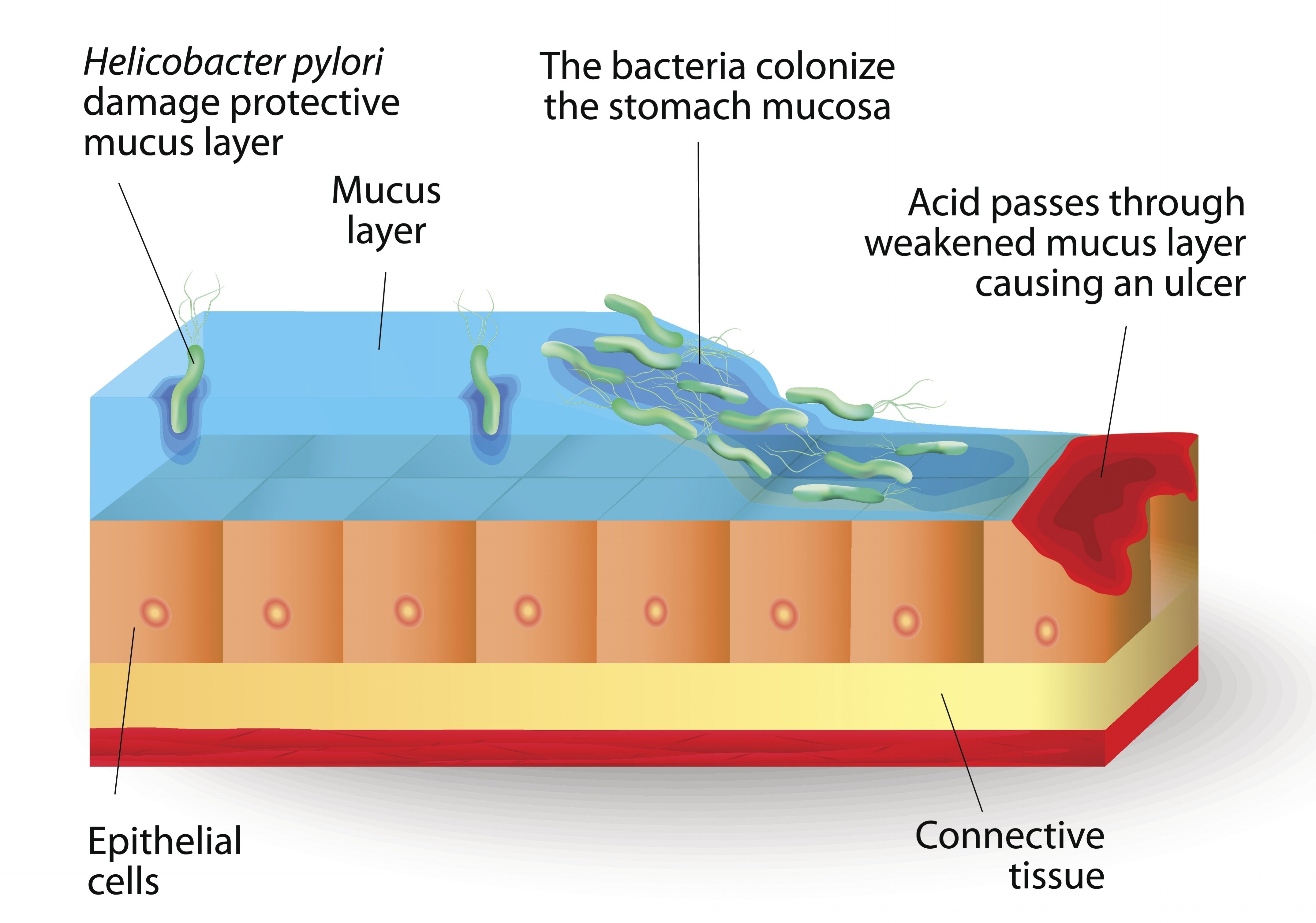 h pylori infection-849635-edited