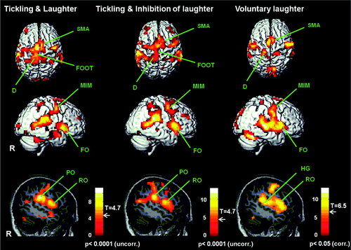 fMRI of a brain visualizing the variety of regions engaged depending on the type of laughter, from volentary to uncontrolled.