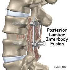 Is There An Alternative To Spinal Fusion Surgery