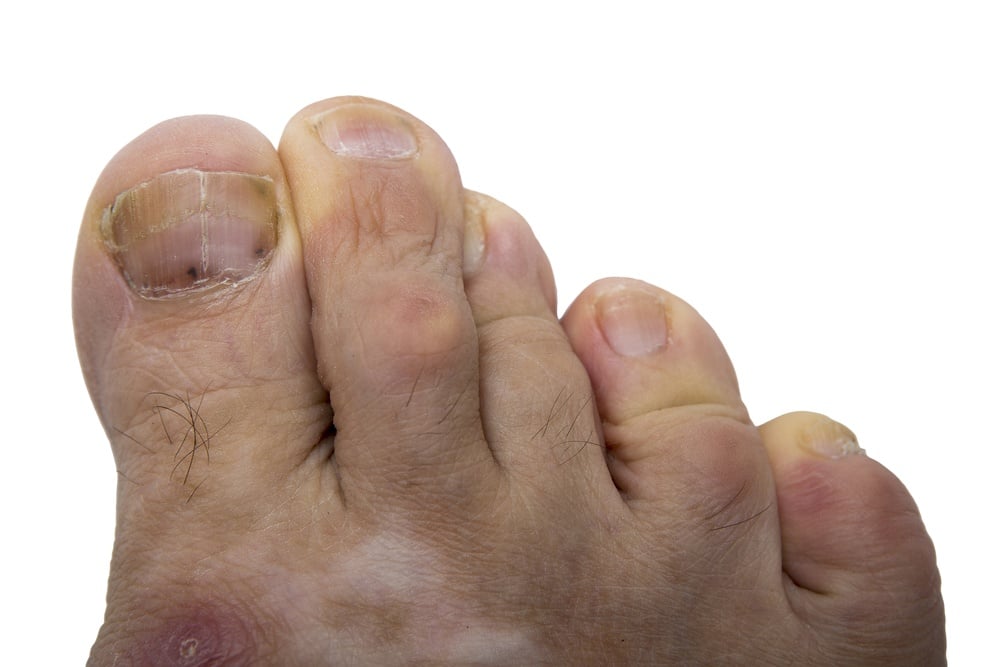 black-spot-under-toenail-melanoma-nail-ftempo