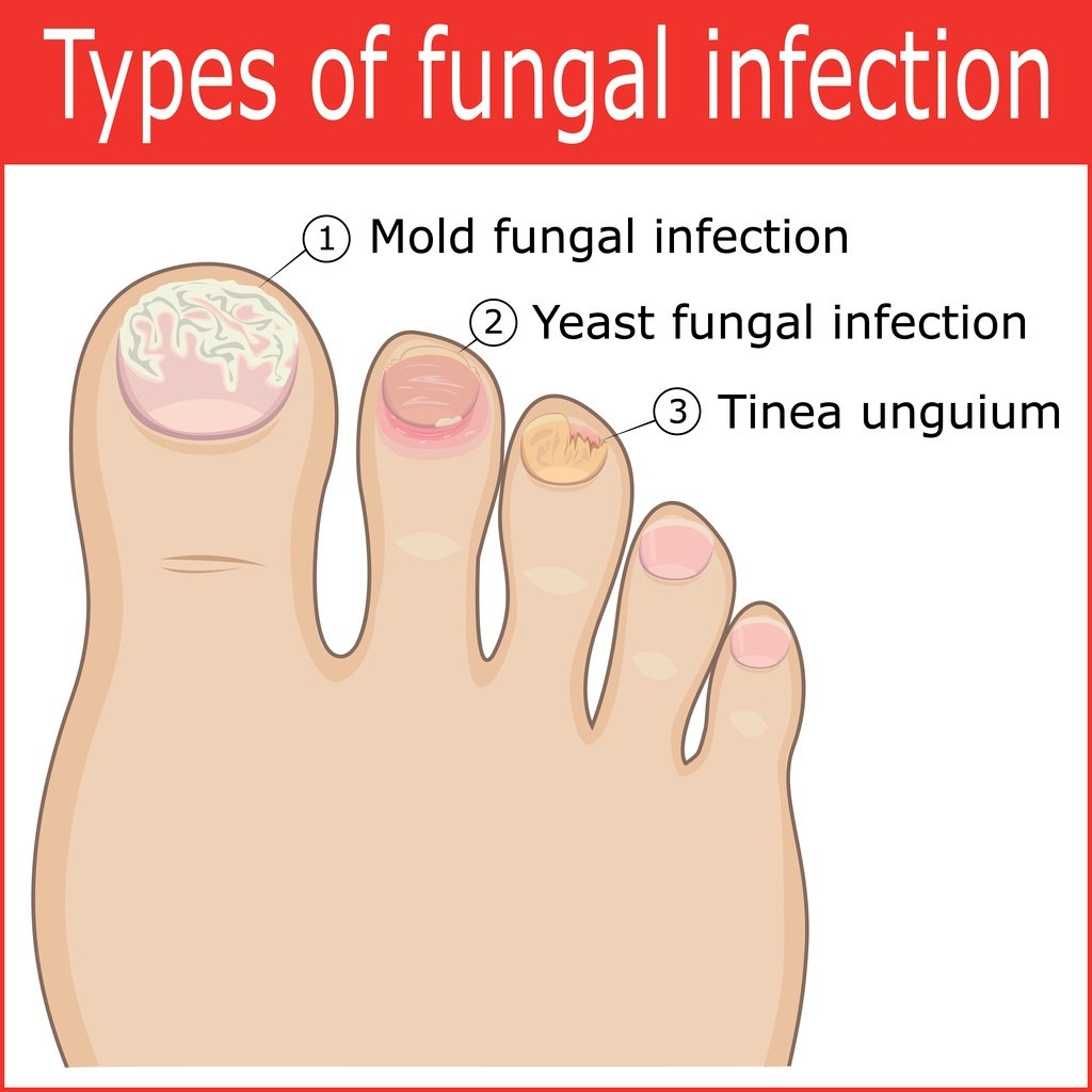 Cure Pain From Toenail Fungus Infection