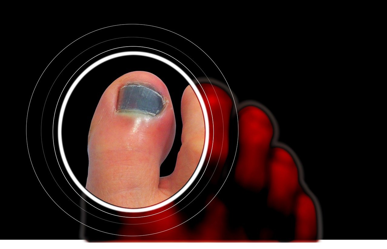 Premium Photo | Big toe nail injury removes dead nail