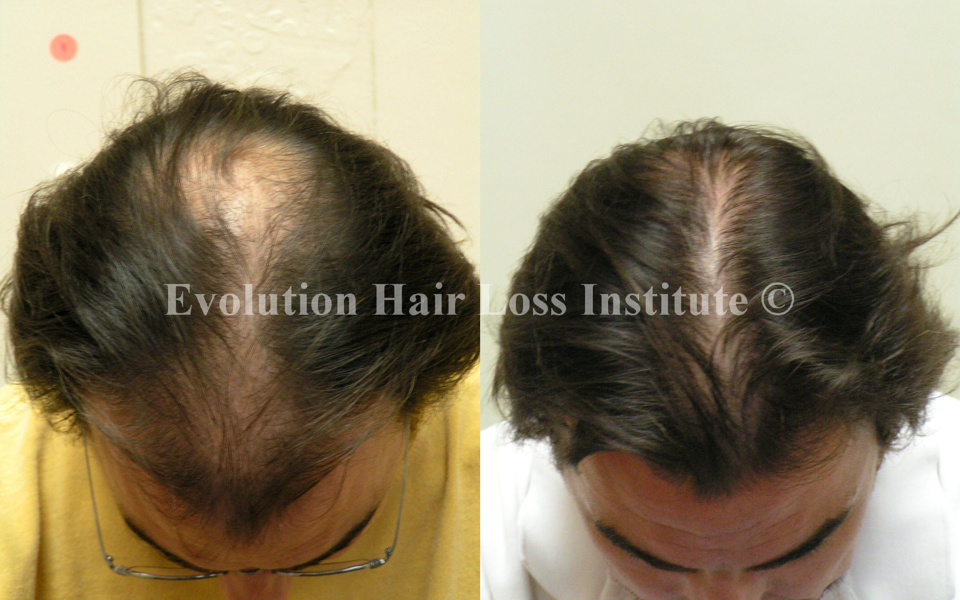 Before and After Hair Growth Treatment Photos