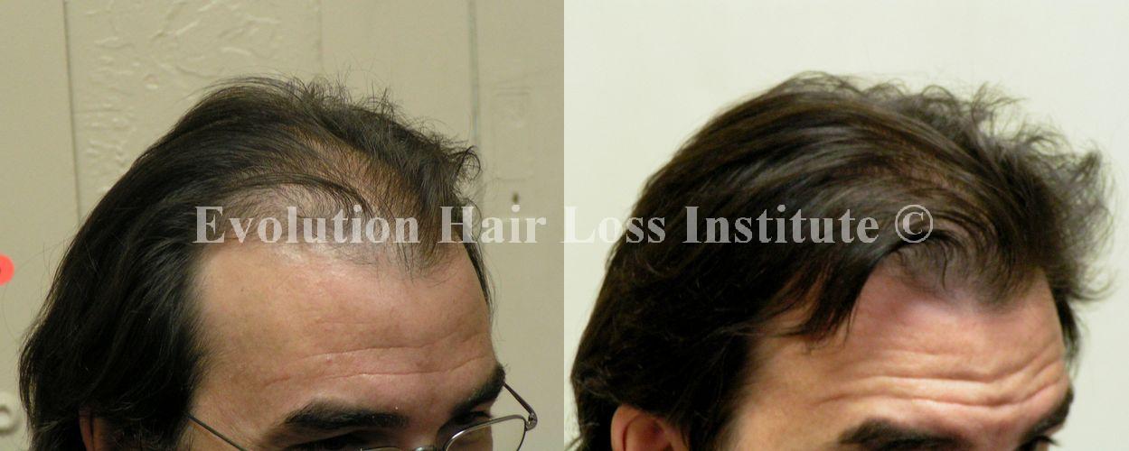 Before and After Hair Growth Treatment Photos