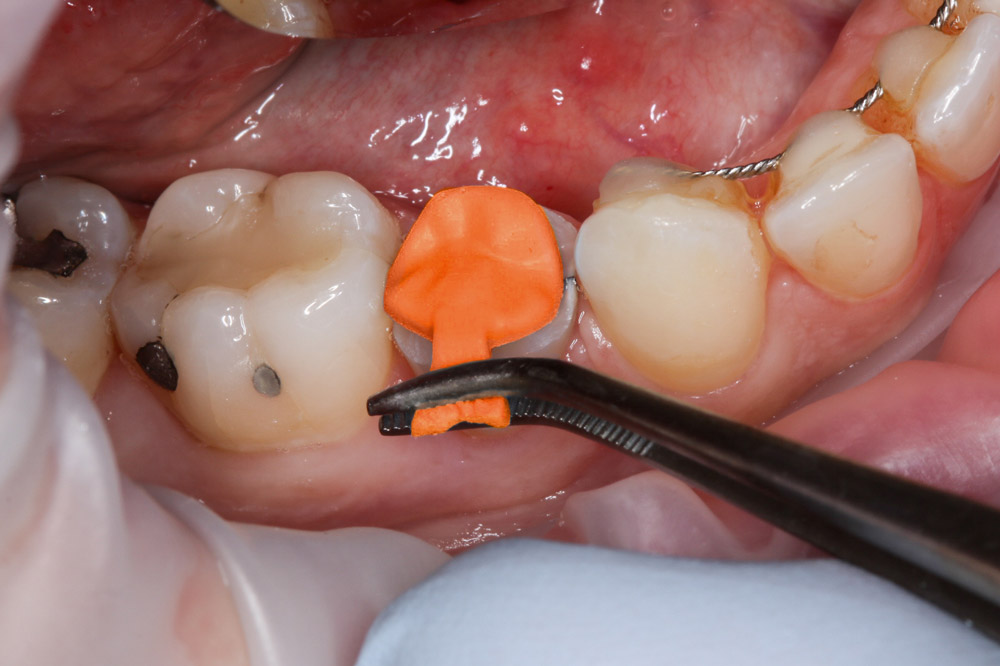 03 checking occlusal spacing with replica