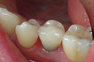 One-Visit-Crown-OVC3-Case-study-OVC-lower-pre-molar-endo-treated-tooth-after-from-side