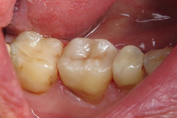 One-Visit-Crown-OVC3-Case-study-ovc3-weakened-molar-after-from-top