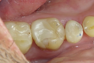 One-Visit-Crown-OVC3-Case-study-ovc3-weakened-molar-before-from-top