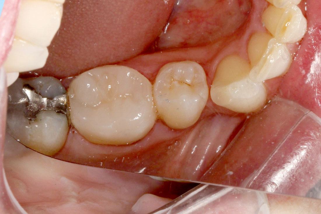 06-Final-Occlusal-view