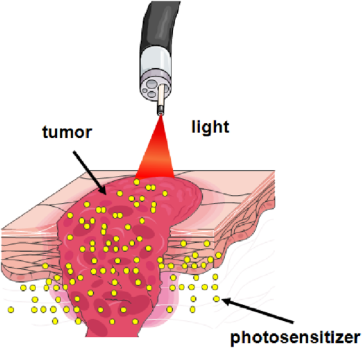 Photodynamic Therapy (PDT)