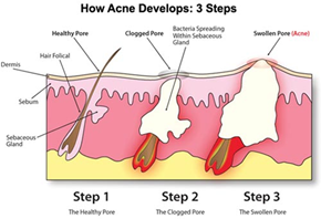 How Acne Develops