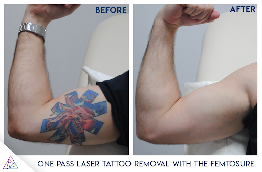 Tattoo Removal Techniques DallasPlanoFriscoAddison  DermaAesthetic and  Laser Center