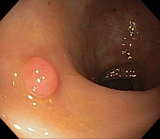 Colonoscopy Quality Measures Withdrawal Time Adr