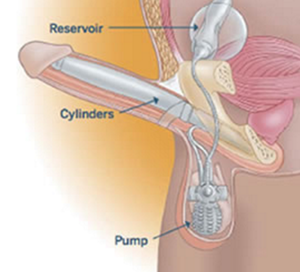 inflatable penile prosthesis-1