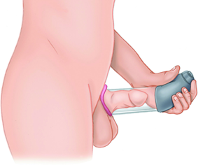 vacuum erection device