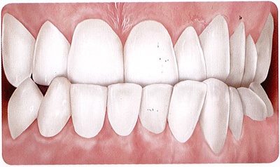 morso incrociato.jpg