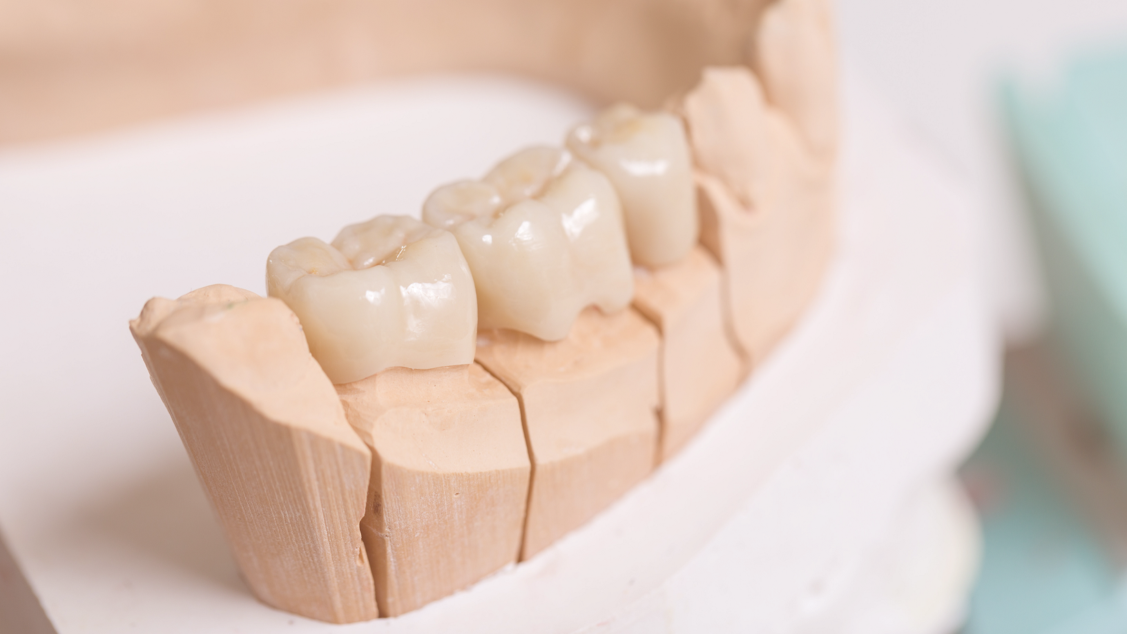 Fixed Dental Bridge - The Best Alternative to Dental Implants