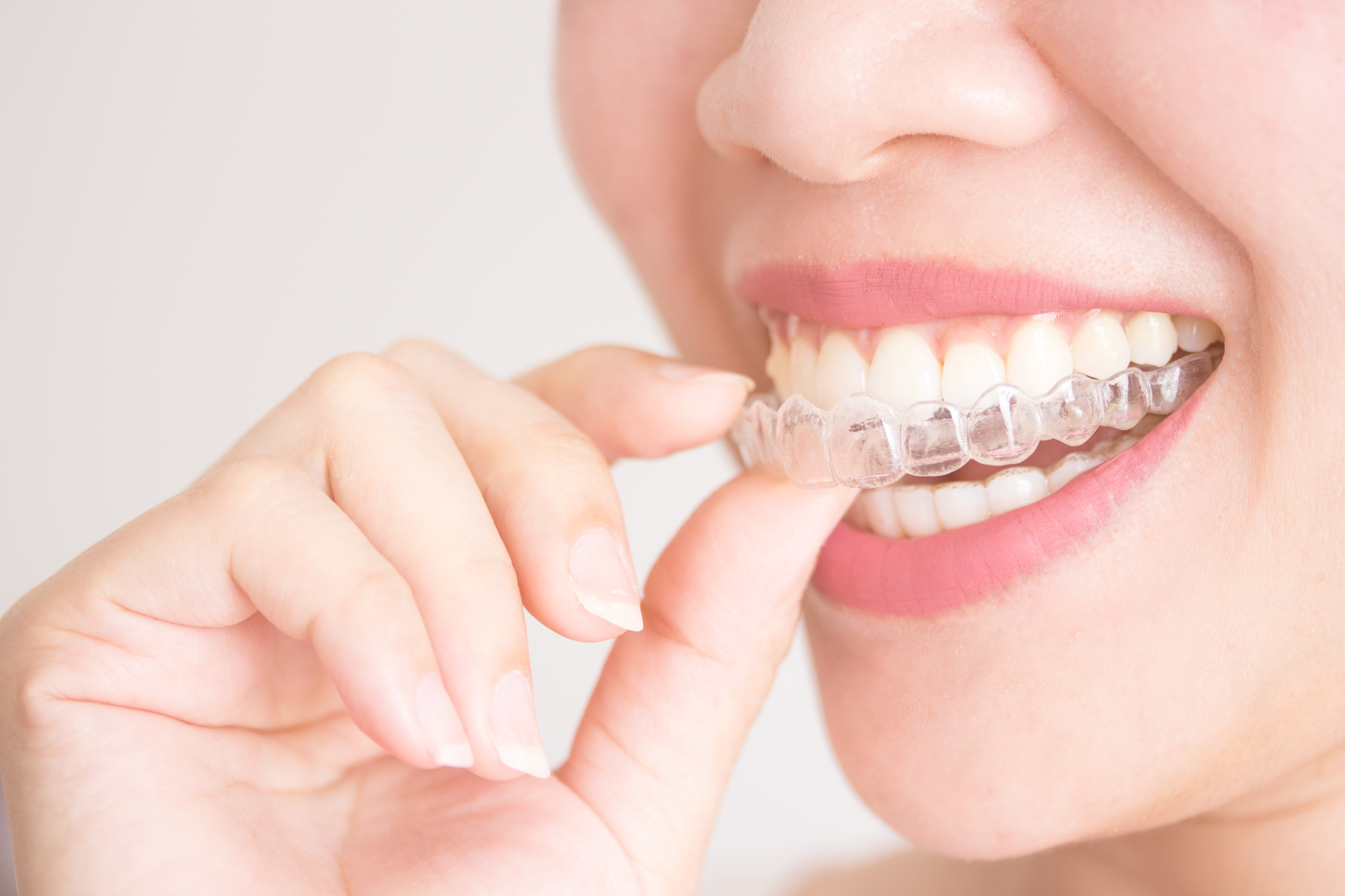 Straighten Your Teeth With Invisalign Clear Aligners