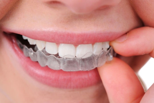 Alternatives for Metal Braces