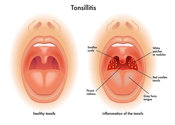 Ear Nose Throat Tonsillitis - C/V ENT Surgical Group