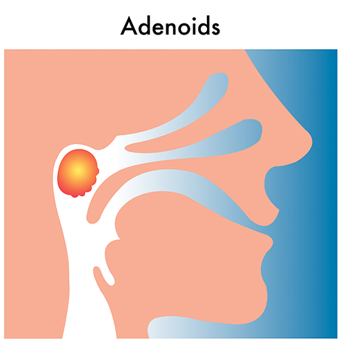 Recurring Ear Infection Adenoids - C/V ENT Surgical Group