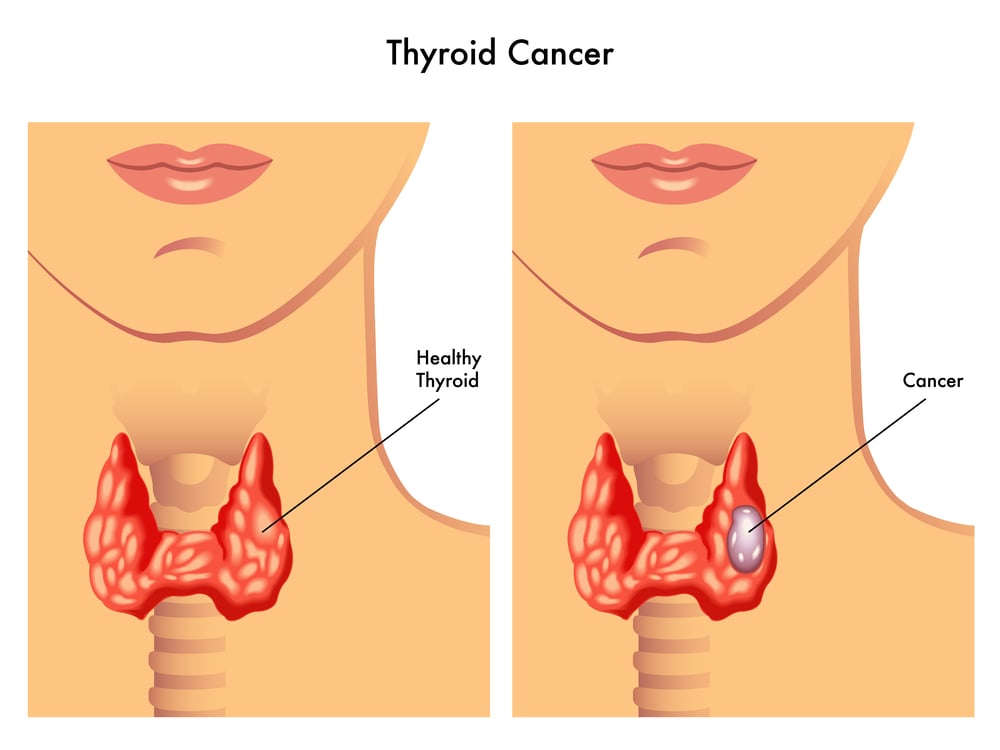 Depositphotos Thyroid Cancer