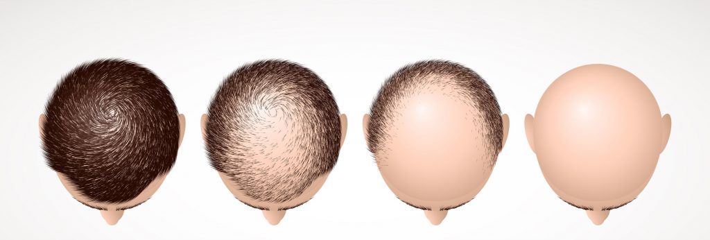 androgenetic-alopecia-min-1024x346