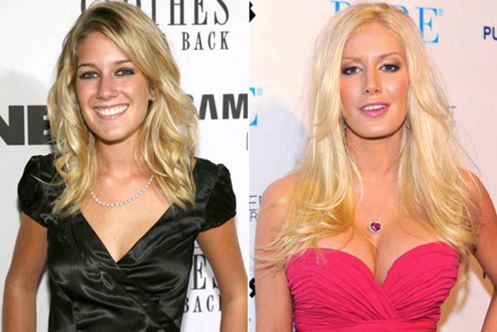 Celebrity Breast Implants: From Secrets to Celebrations