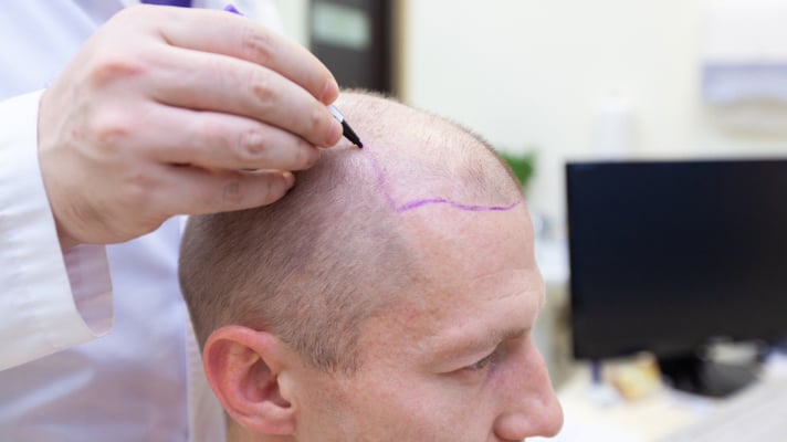preparation-for-the-hair-transplant