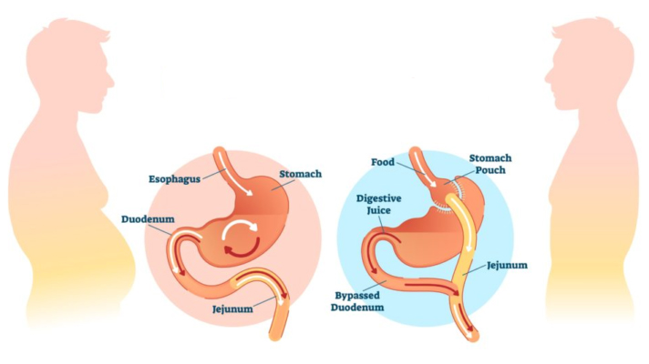 treatment-of-obesity-gastric-bypass-overview