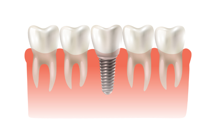 what-are-the-most-common-dental-procedures-implants