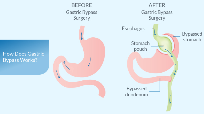 what-is-gastric-bypass-1