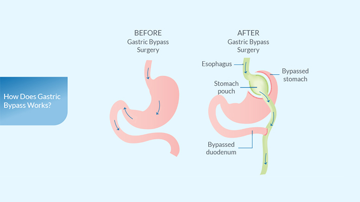 what-is-gastric-bypass