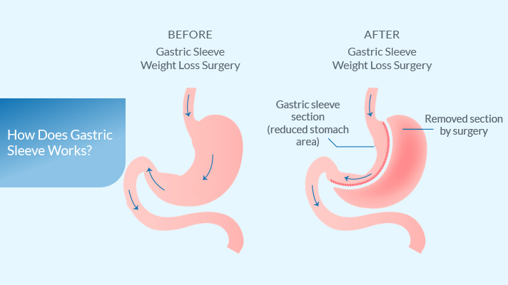 what-is-gastric-sleeve-1