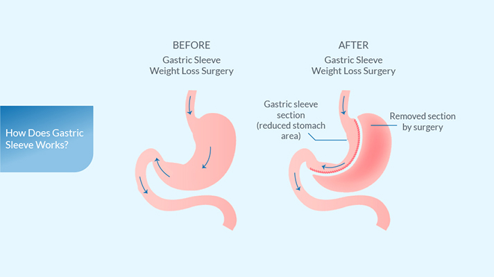 what-is-gastric-sleeve