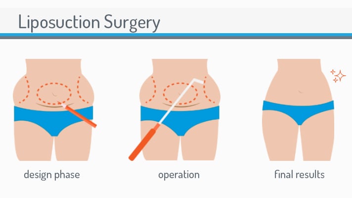 what-is-liposuction