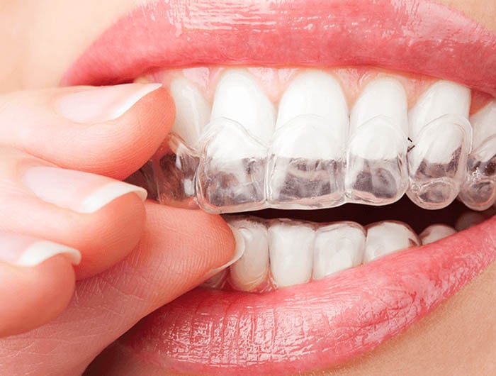 All Rights Reserved Invisalign Teen