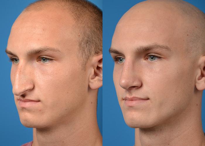 Male Rhinoplasty | Melbourne, FL | Patient 11244