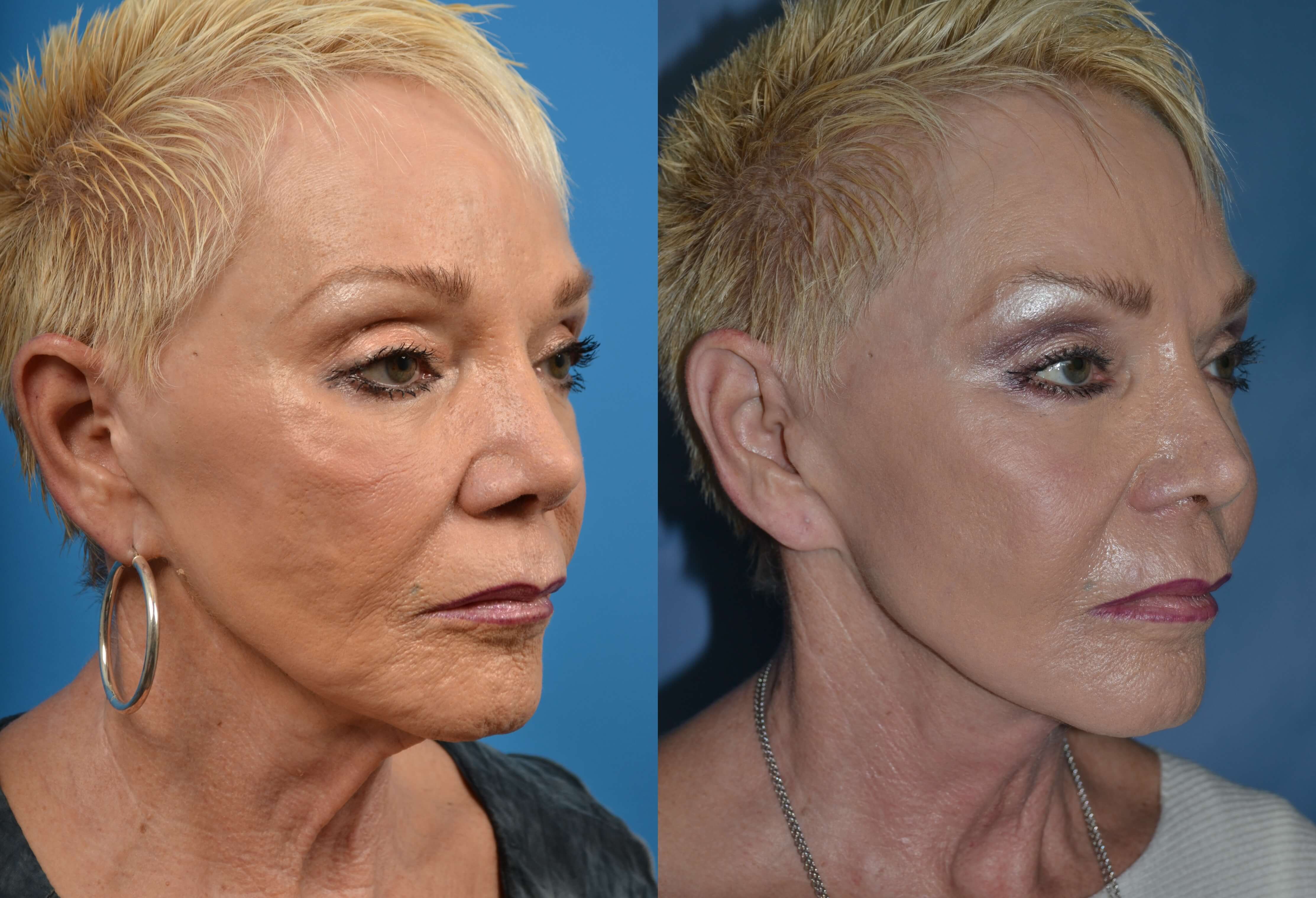Facial Resurfacing: The Celebrity Skin Secret Revealed - 8d0666n
