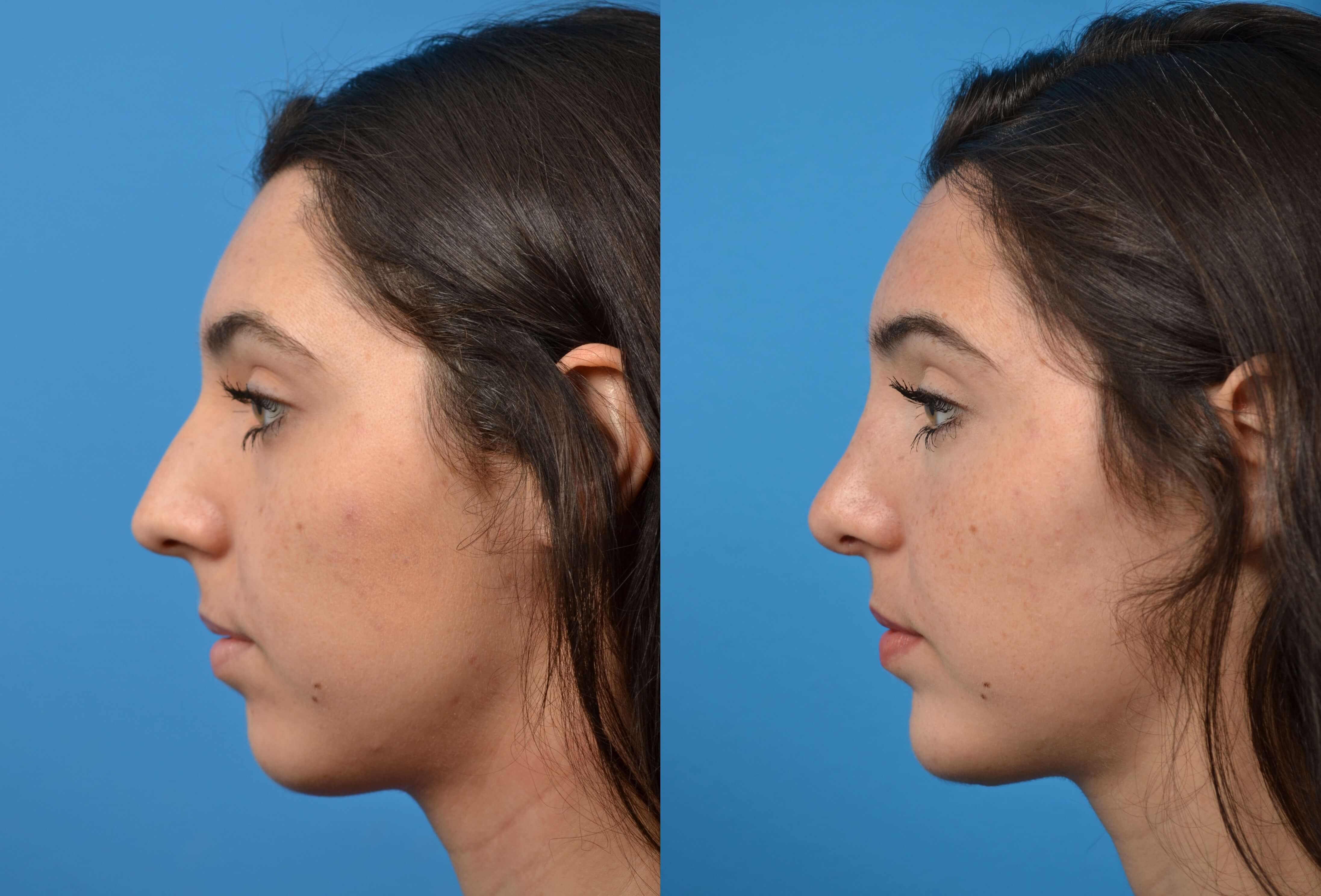 Chin Augmentation Photos Melbourne Fl Patient 16156