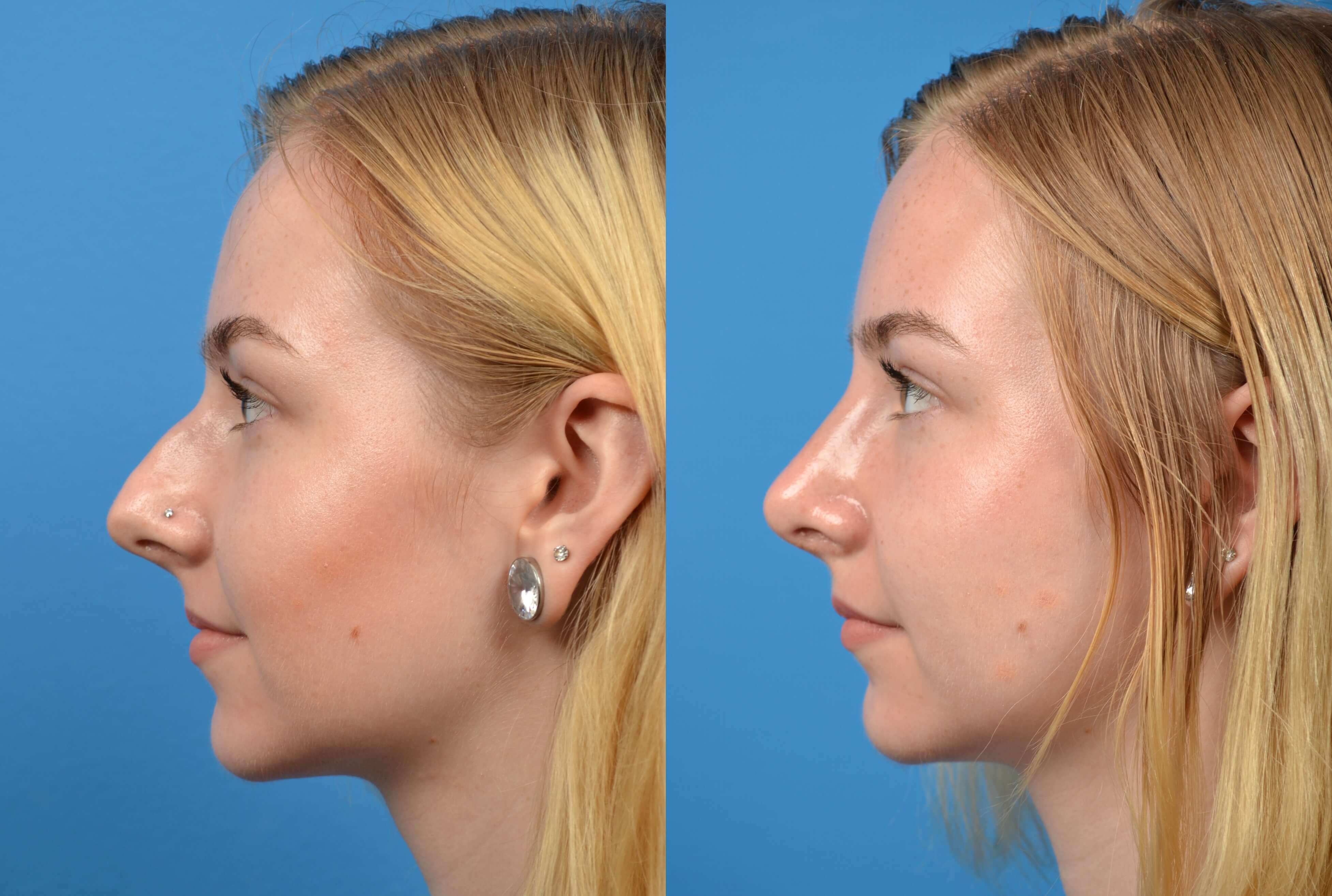 Can I Cry After Rhinoplasty: Understanding the Impact on Healing ...