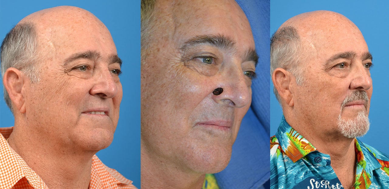 Mohs Surgery Before And After