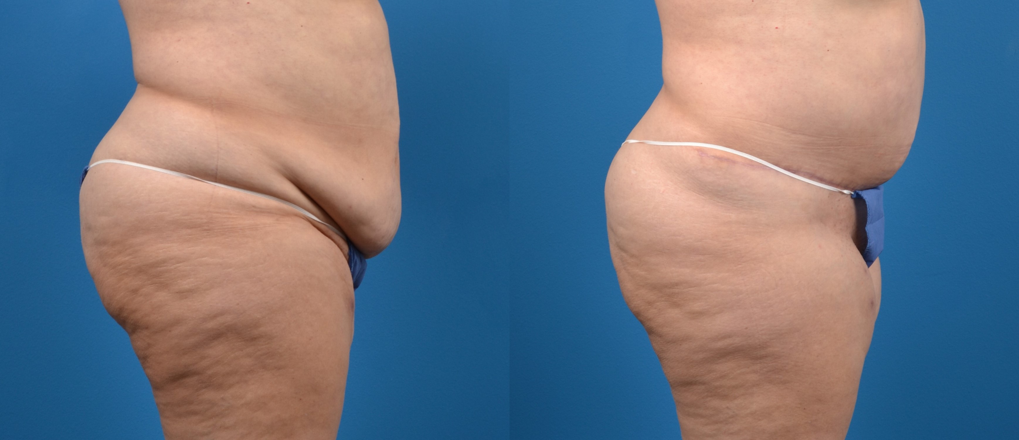 Patient 28601, Tummy Tuck before and after pictures Tummy Tuck before and after pictures in Melbourne, FL, Patient 28601
