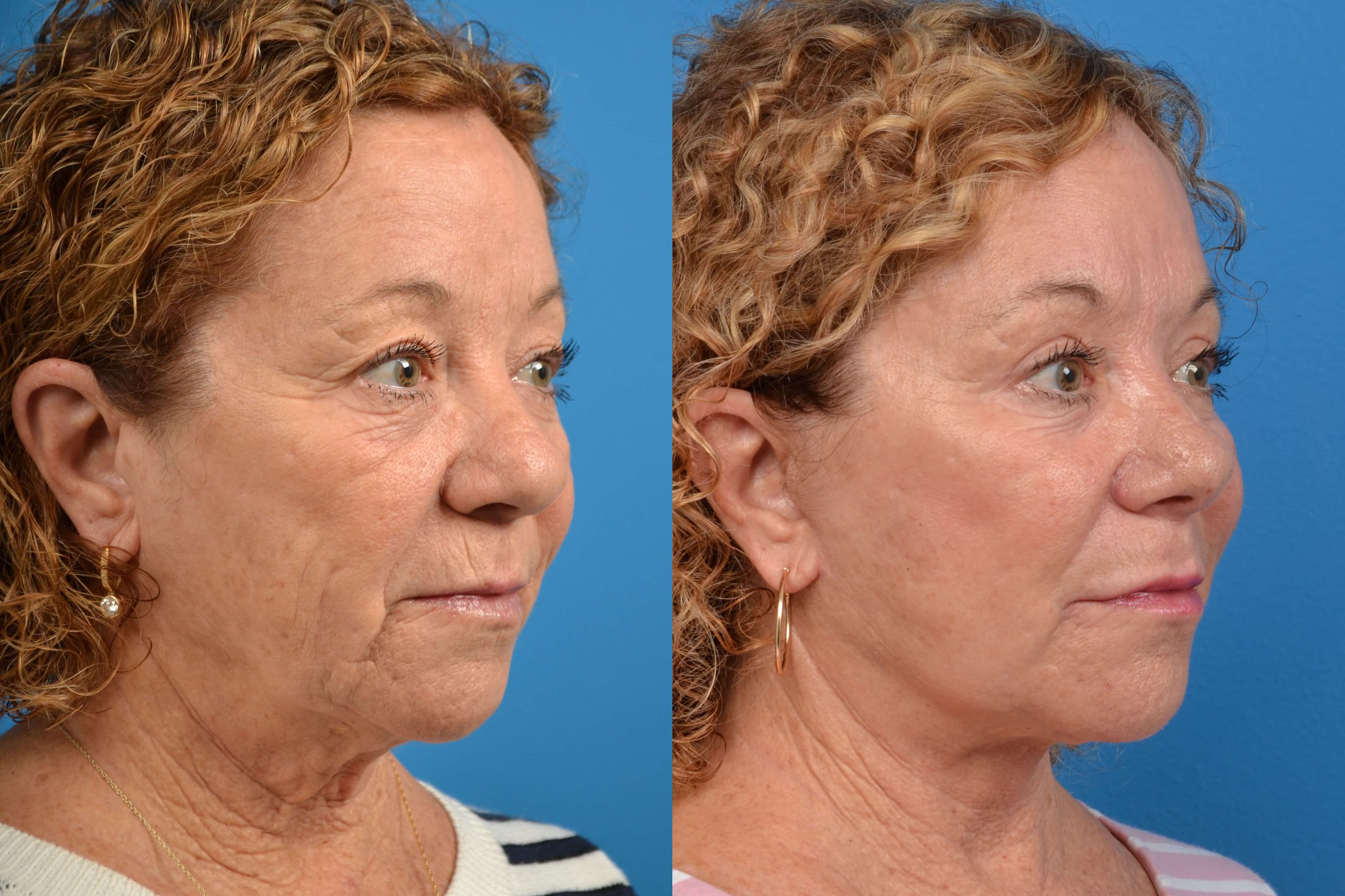 Facelift Photos | Melbourne, FL | Patient 28960