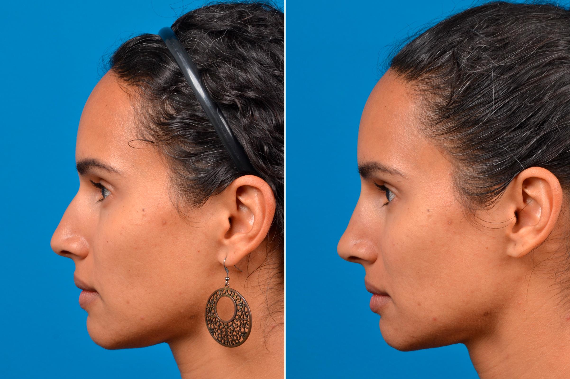liquid rhinoplasty before and after