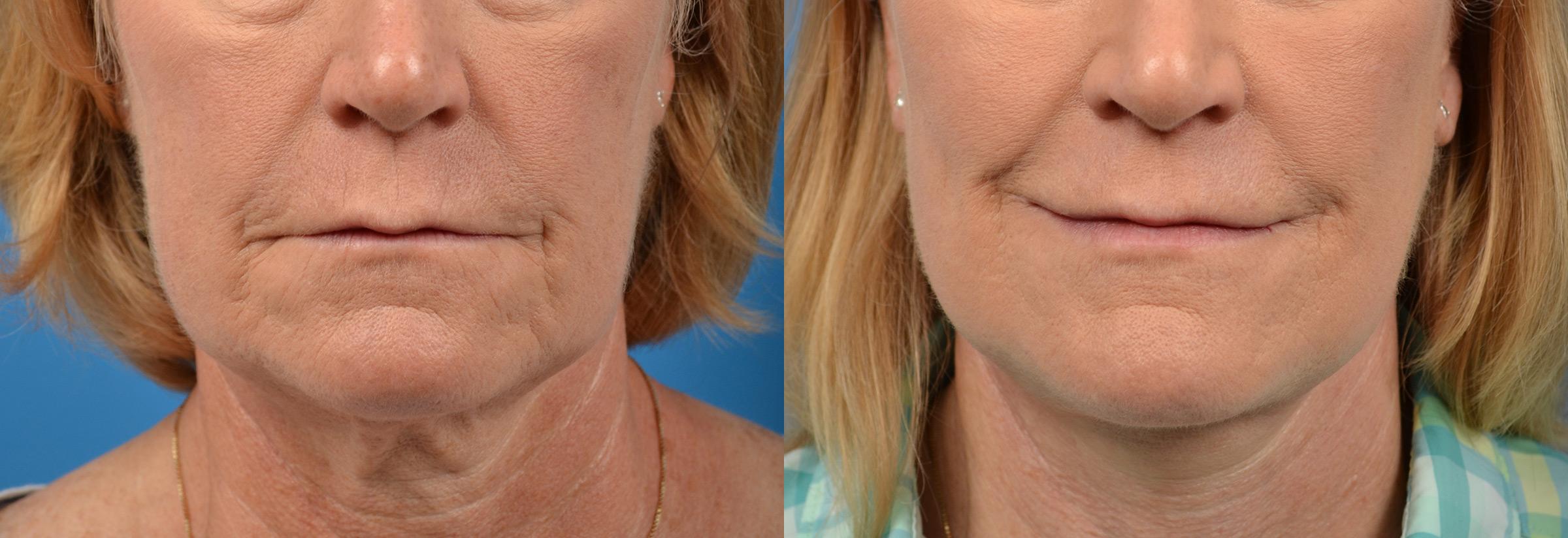 Lip Augmentation Surgery in Central Florida