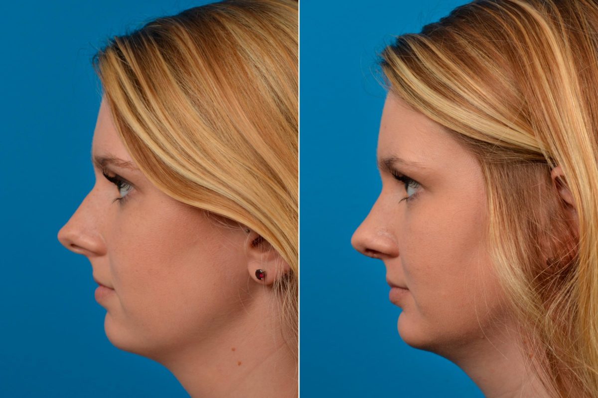 chin tuck procedure
