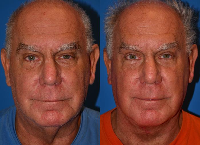 Male Eyelid Surgery Photos | Melbourne, FL | Patient 28867